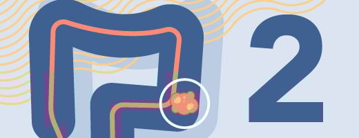 Colorectal cancer is the 2nd leading cause of death among cancers that affect U.S. adults of both sexes. Colorectal cancer is the 2nd leading cause of death among cancers that affect U.S. adults of both sexes.